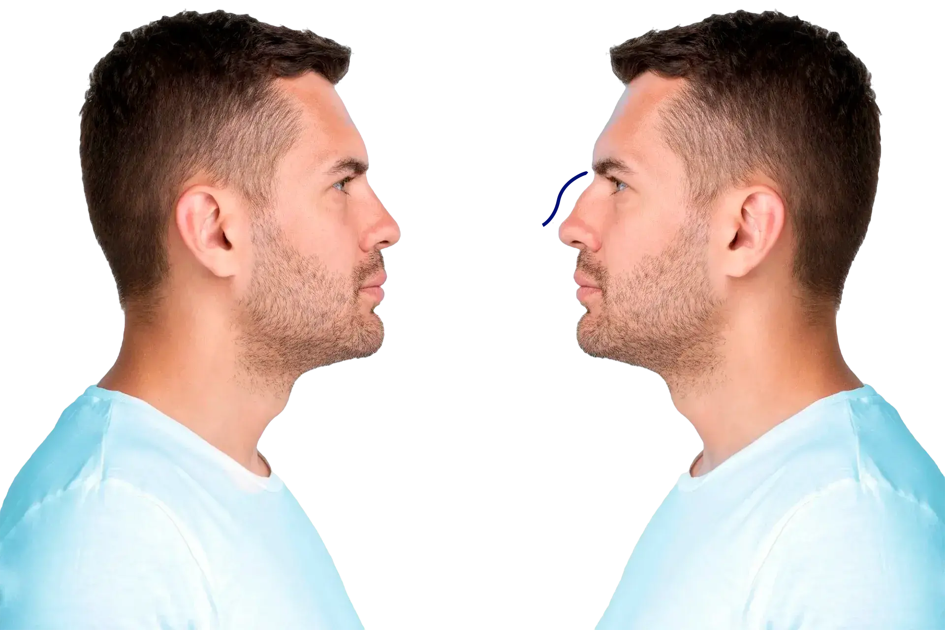 rinomodelación con Ácido Hialurónico